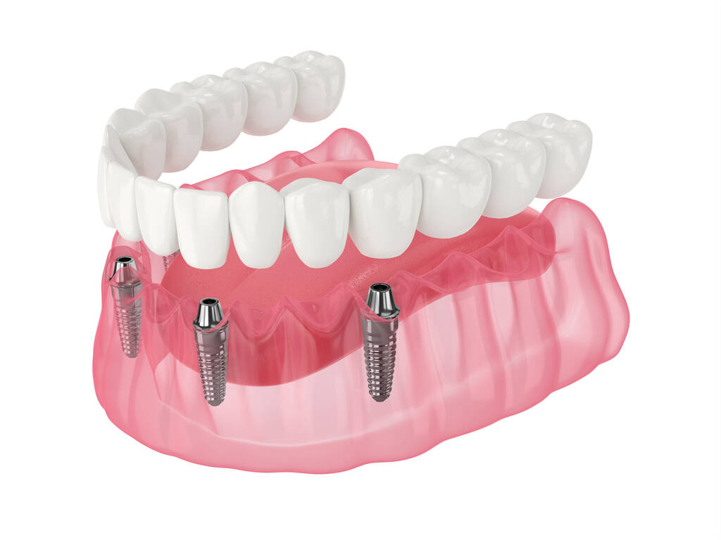 What Are The Benefits Of All On 4 Dental Implants